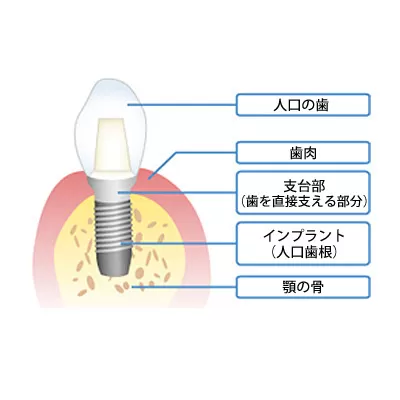 インプラント治療の取り組み方